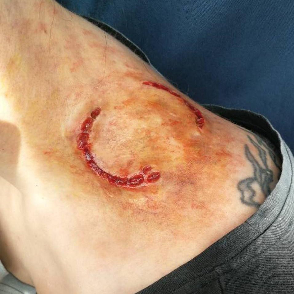 Bloody zombie bite prosthetic wound on a shoulder